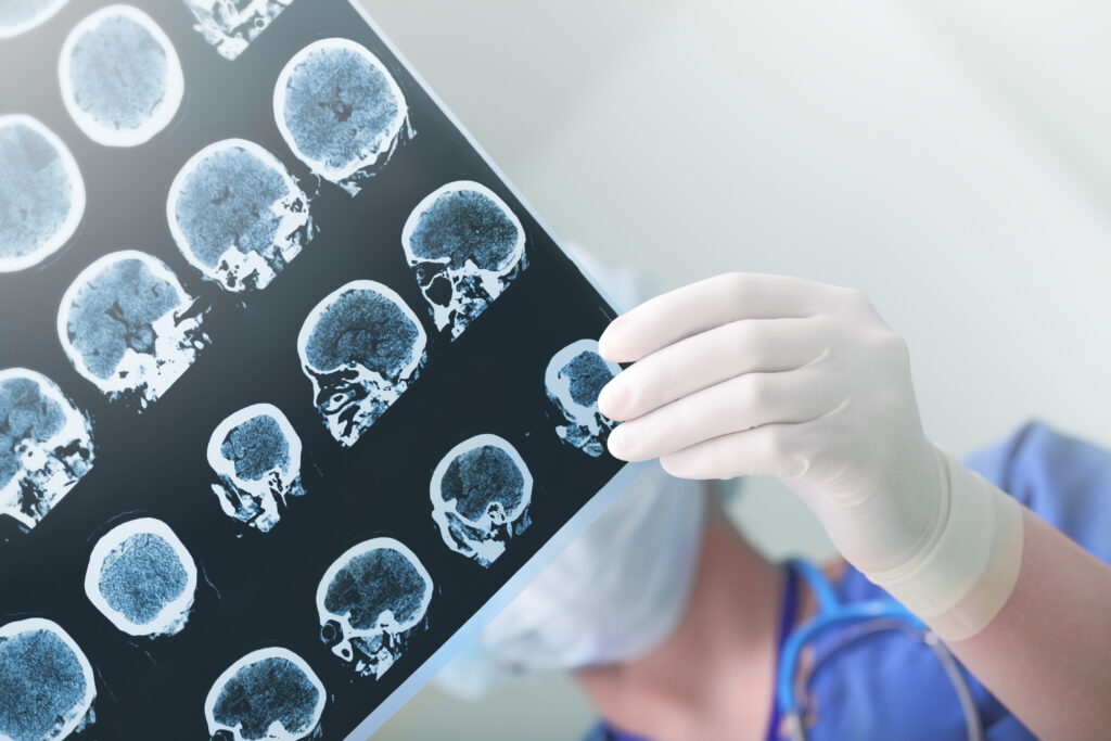 Traumatic brain injury from a car accident